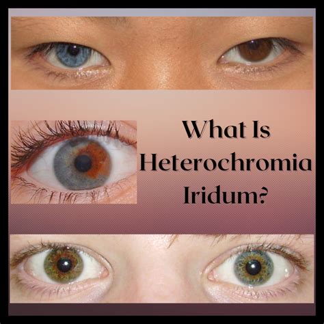 heterochromia pinay|HETEROCHROMIA IRIDIS .
